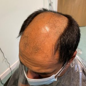 Man getting prepped for hair replacement in Stockport