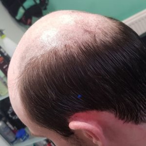 Non surgical hair replacement in Manchester and Stockport