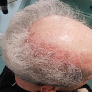 Elderly woman with hair loss in Stockport