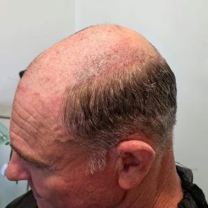 Hair loss treatment Manchester