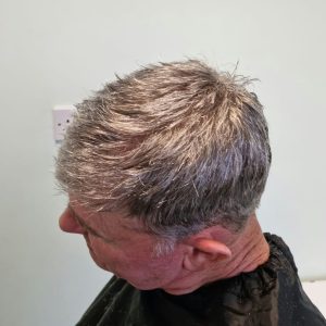 Non-surgical hair loss treatment Stockport